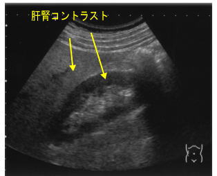 fatty liver.jpg fatty liver.jpg